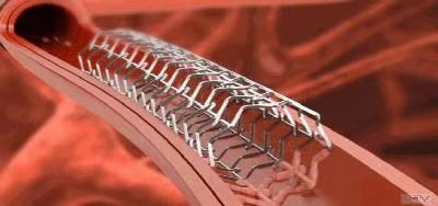 顯影環(huán)去毛刺處理工藝